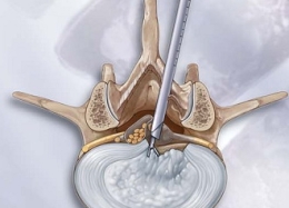 Dụng cụ phẫu thuật nội soi cột sống ngực và thắt lưng - Thiết Bị Y Tế Thành Phương - Công Ty TNHH Thành Phương