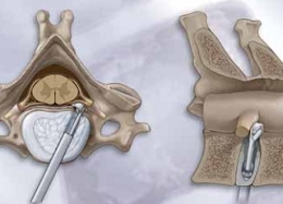 Dụng cụ phẫu thuật nội soi đĩa đệm cột sống cổ - Thiết Bị Y Tế Thành Phương - Công Ty TNHH Thành Phương