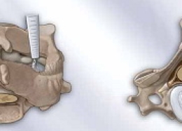 Dụng cụ phẫu thuật nội soi đĩa đệm cột sống cổ - Thiết Bị Y Tế Thành Phương - Công Ty TNHH Thành Phương