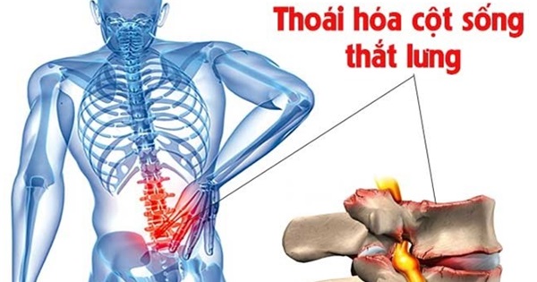 Thoái hóa cột sống