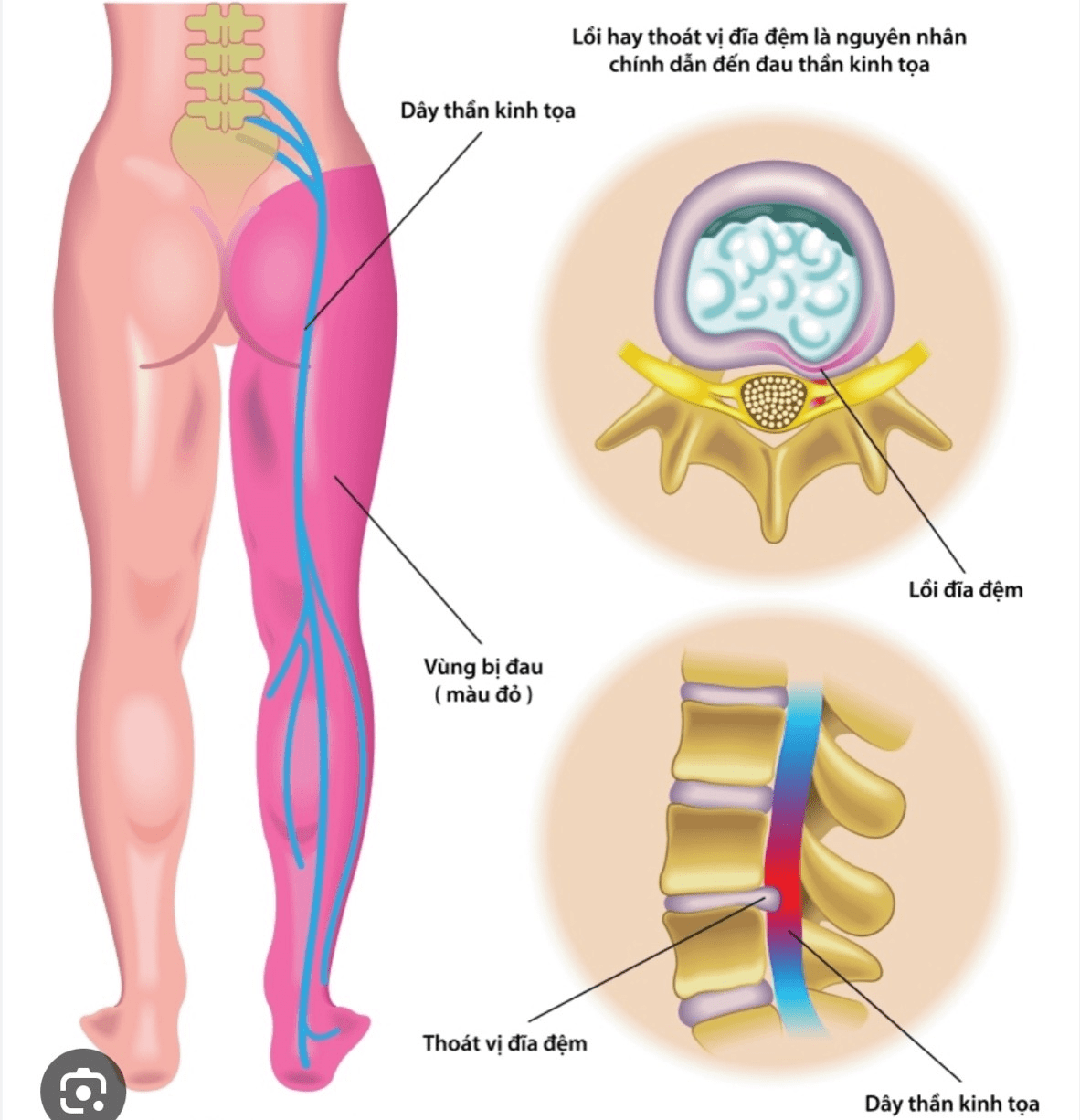 Thoát vị đĩa đệm