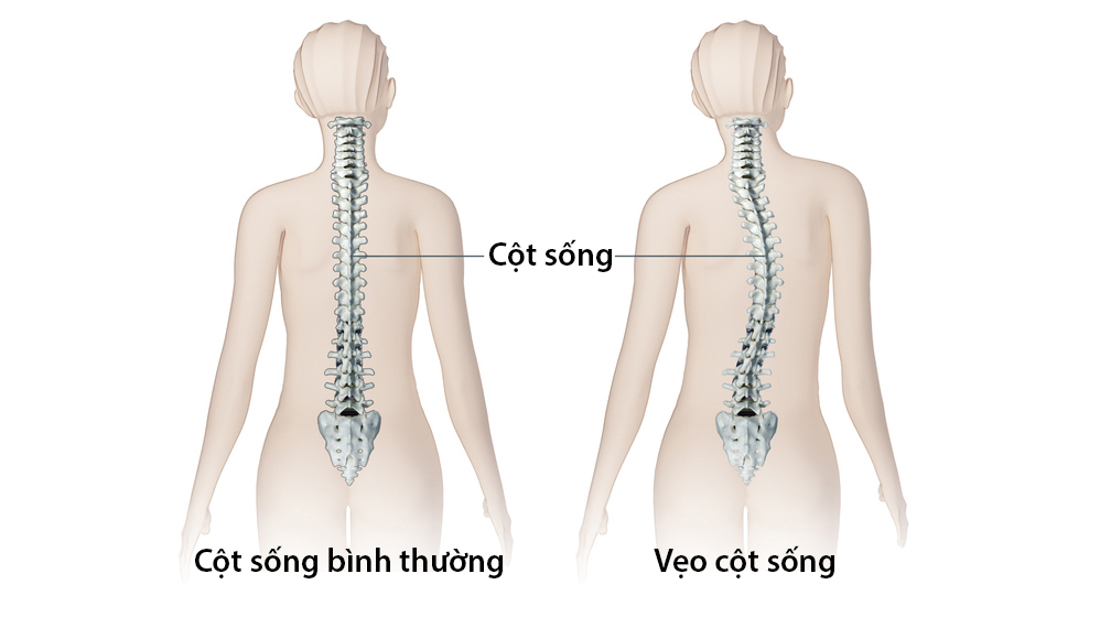 Vẹo cột sống