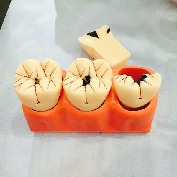 Mô hình răng sâu