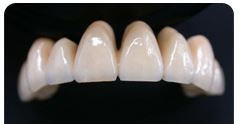 Răng sứ kim loại - Thiết Bị Y Tế Katri - Công Ty CP Thiết Bị Y Tế Katri