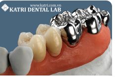 Răng sứ kim loại - Thiết Bị Y Tế Katri - Công Ty CP Thiết Bị Y Tế Katri
