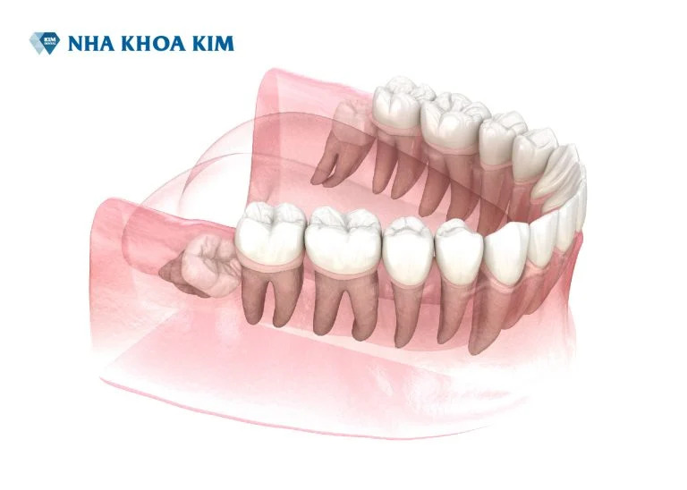 Dịch vụ nhổ răng khôn