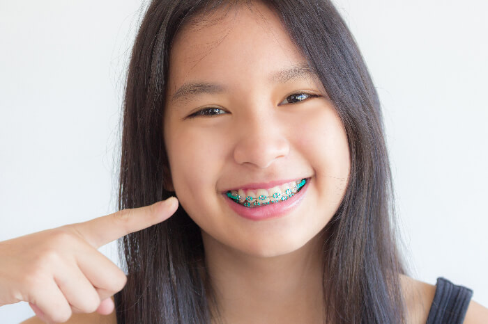 Dịch vụ niềng răng cho trẻ em