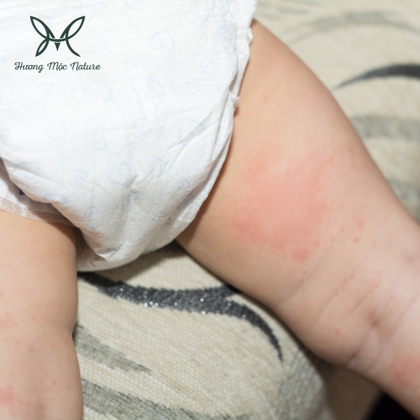 Gia công kem bôi da chống hăm cho bé - Hóa Mỹ Phẩm Hương Mộc - Công Ty Cổ Phần Hóa Mỹ Phẩm Hương Mộc