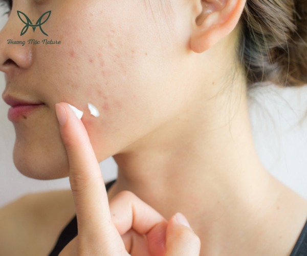 Gia công kem trị mụn cho bà bầu - Hóa Mỹ Phẩm Hương Mộc - Công Ty Cổ Phần Hóa Mỹ Phẩm Hương Mộc