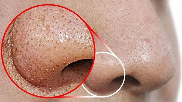 Điều trị mụn trứng cá - Linh Na Spa - Công Ty Cổ Phần Thuận Tài Phát