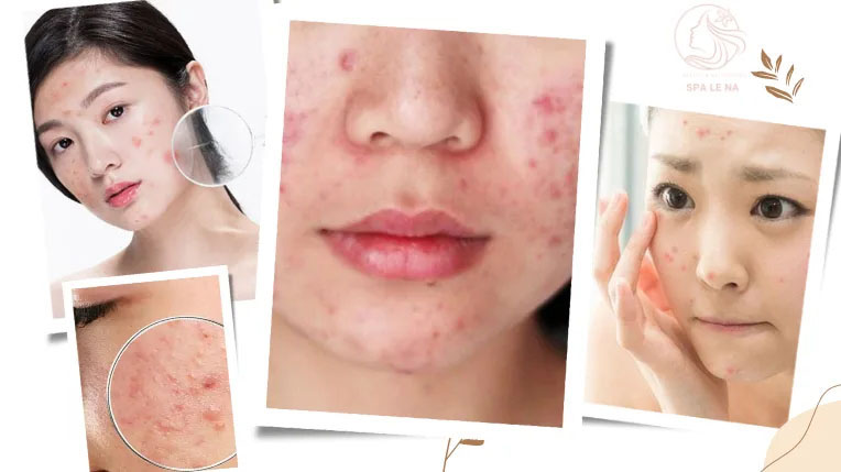 Điều trị mụn tuổi dậy thị - Linh Na Spa - Công Ty Cổ Phần Thuận Tài Phát