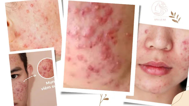 Điều trị mụn viêm và mụn bọc - Linh Na Spa - Công Ty Cổ Phần Thuận Tài Phát