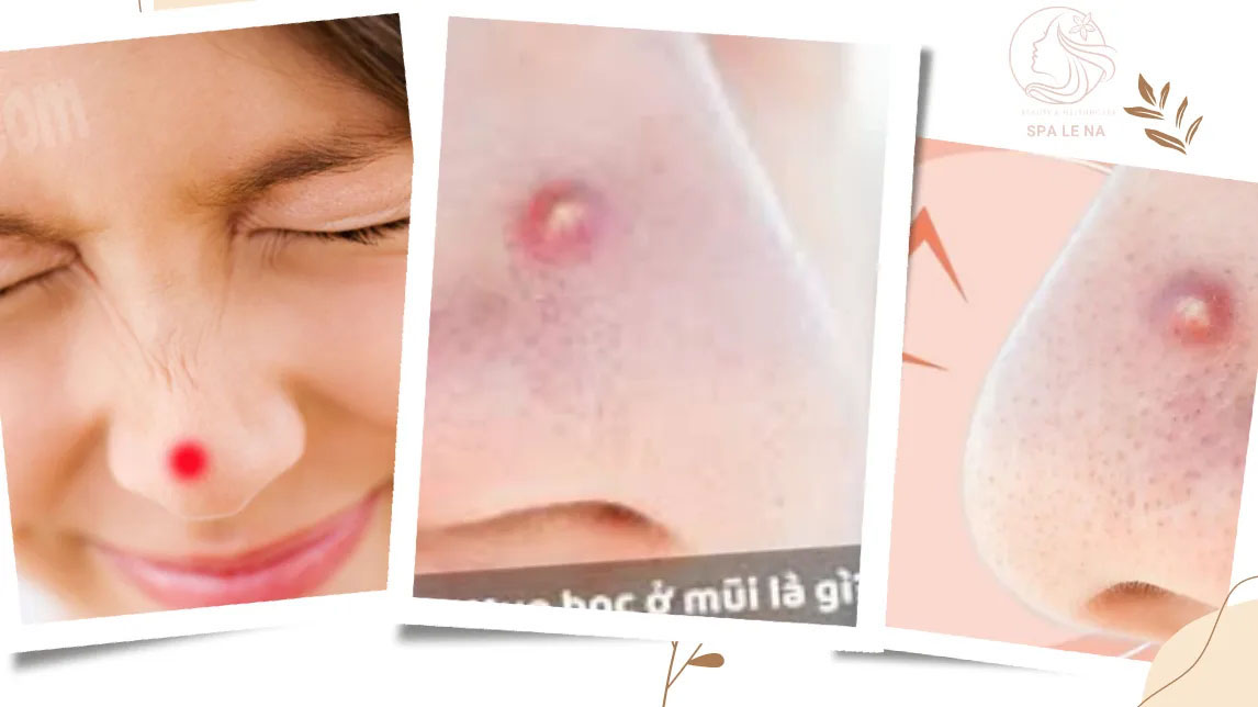 Điều trị mụn bọc ở mũi - Linh Na Spa - Công Ty Cổ Phần Thuận Tài Phát