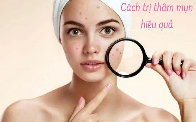 Điều trị mụn thâm hiệu quả - Linh Na Spa - Công Ty Cổ Phần Thuận Tài Phát