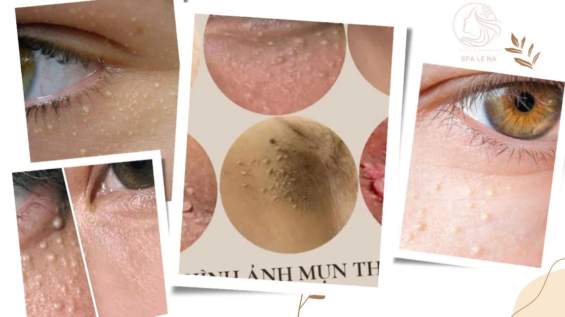 Điều trị mụn thịt - Linh Na Spa - Công Ty Cổ Phần Thuận Tài Phát