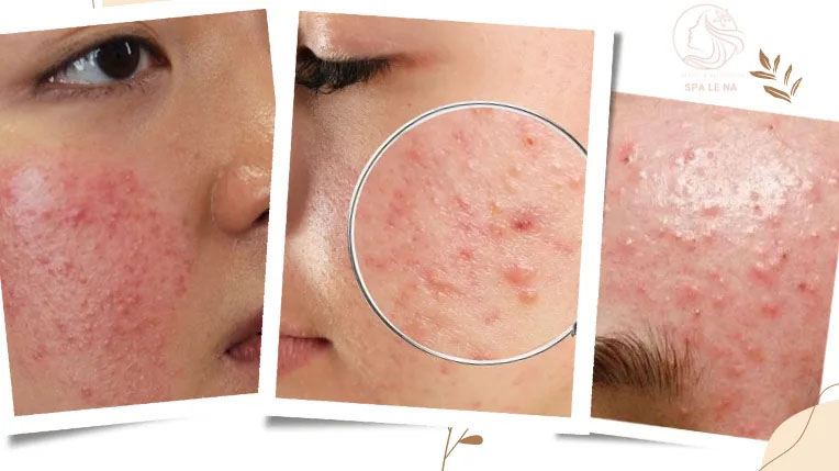 Điều trị mụn ẩn, mụn viêm đỏ - Linh Na Spa - Công Ty Cổ Phần Thuận Tài Phát