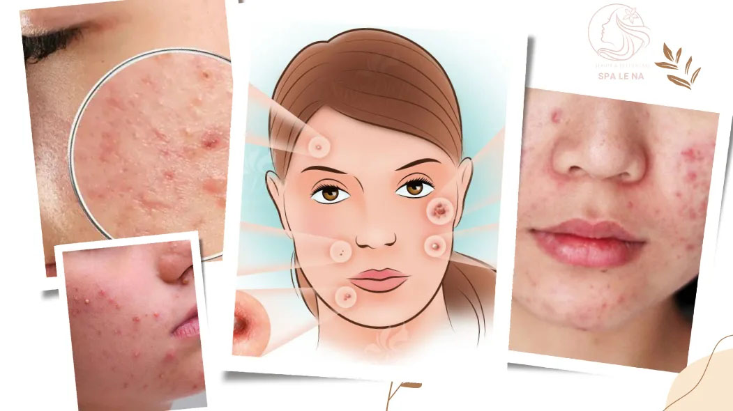 Điều trị mụn trứng cá - Linh Na Spa - Công Ty Cổ Phần Thuận Tài Phát