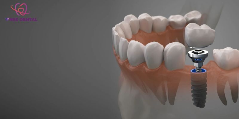 Cấy răng Implant