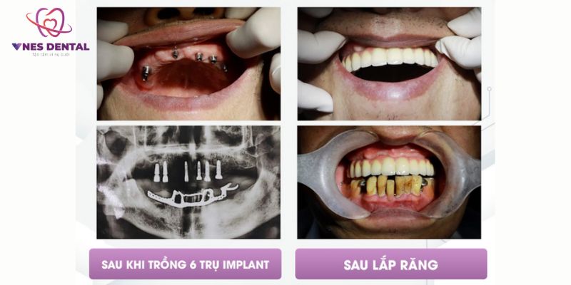 Cấy răng Implant