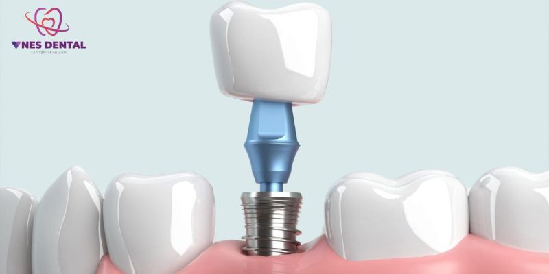 Cấy răng Implant