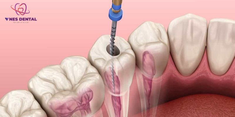 Điều trị nội nha