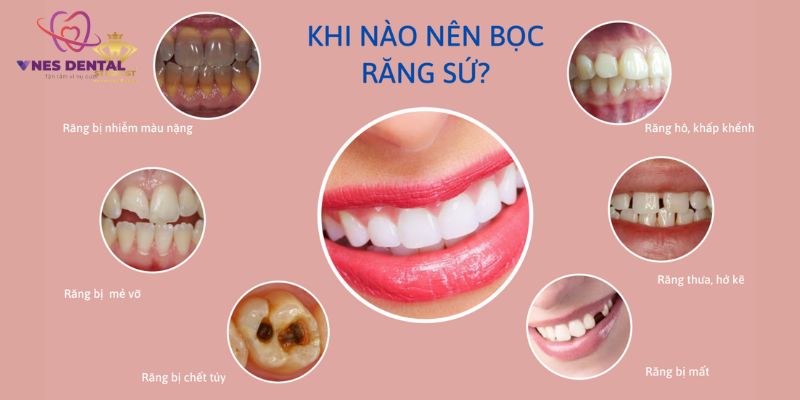 Thẩm mỹ răng sứ