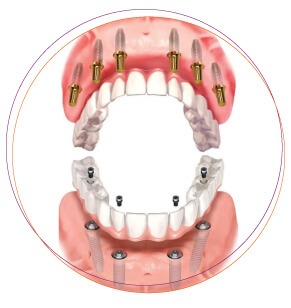 All-on-4, all-on-6 toàn hàm