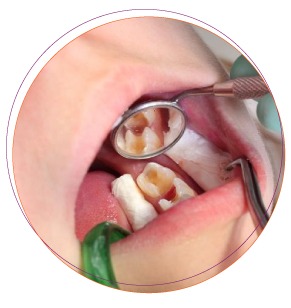 Chữa tủy răng sữa