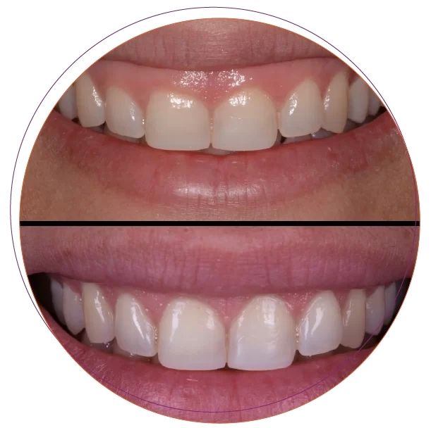 Điều trị cười hở nướu