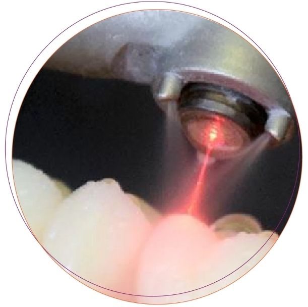 Điều trị răng nhạy cảm bằng Laser Lightwalker 2017