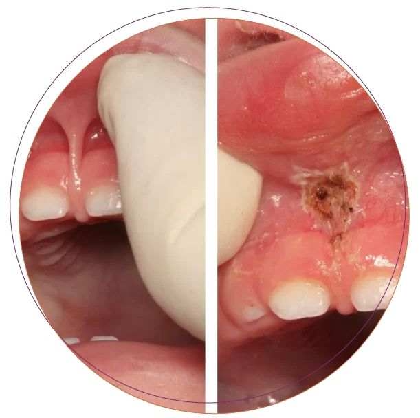 Điều chỉnh thắng môi, thắng lưỡi