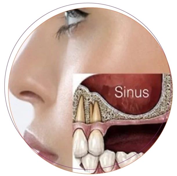 Ghép xương, nâng xoang