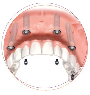Implant và cầu răng