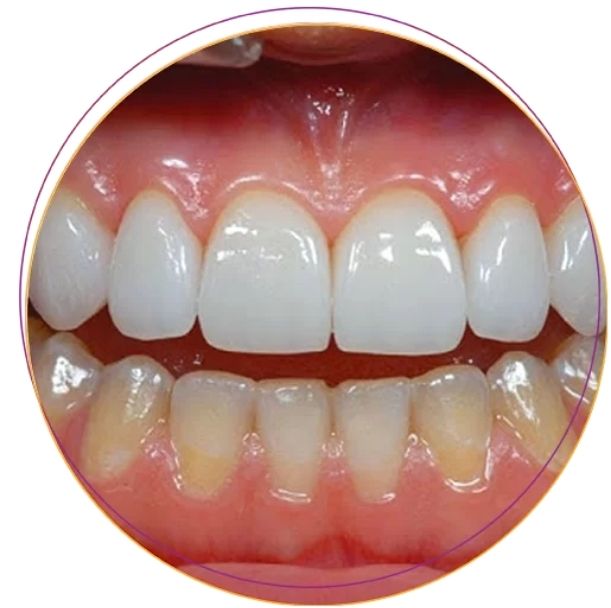 Làm hồng nướu răng với Laser Lightwalker