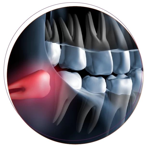 Nhổ răng khôn không đau