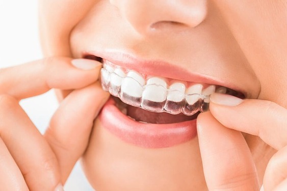 Niềng răng Invisalign