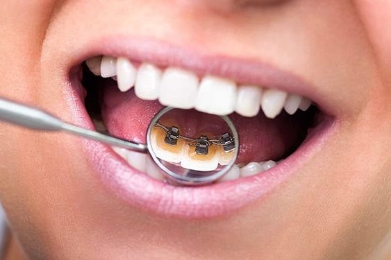 Niềng răng mắc cài mặt lưỡi