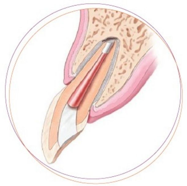 Phẫu thuật cắt chóp