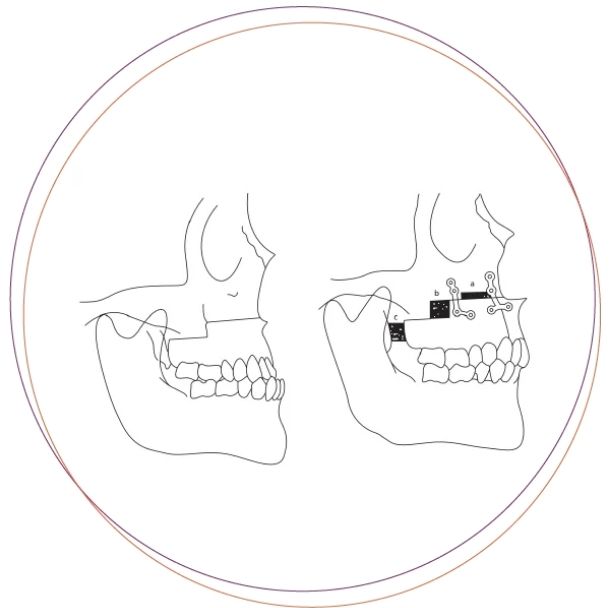 Phẫu thuật chỉnh móm