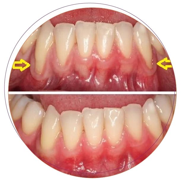 Phẫu thuật ghép nướu