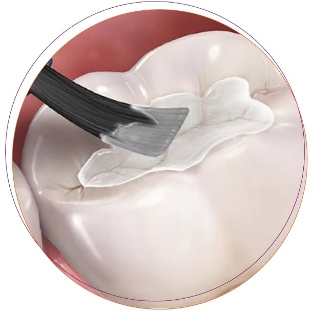 Trám răng phòng ngừa