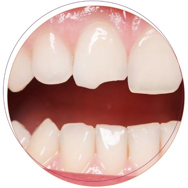 Trám răng sâu sứt mẻ