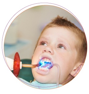 Trám Sealant phòng ngừa sâu răng