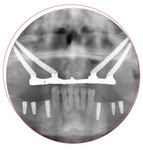 Zygoma implant