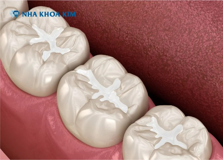 Dịch vụ hàn trám răng