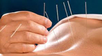 Dịch vụ châm cứu