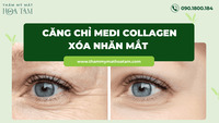 Căng chỉ Medi Collagen xóa nhăn mắt không đau không biến chứng